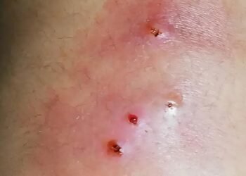 Escala crisis por gusano barrenador en humanos; Yucatán segundo foco nacional