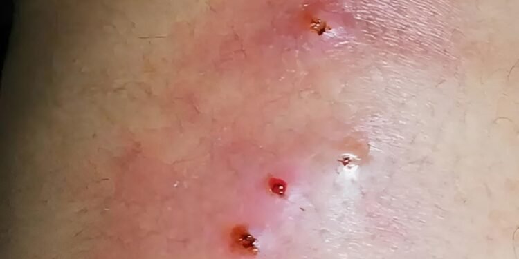 Escala crisis por gusano barrenador en humanos; Yucatán segundo foco nacional