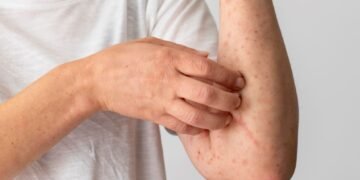 Ojo con el sarampión: sigue activo y al alza