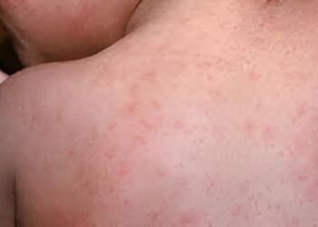 El sarampión no cede y sube 40 por ciento en Yucatán