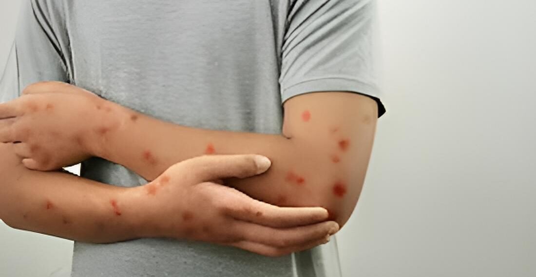 Se confirma caso de Mpox; el estado es la segunda entidad con más contagios