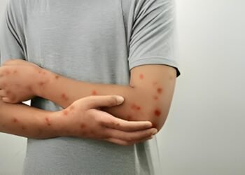 Se confirma caso de Mpox; el estado es la segunda entidad con más contagios