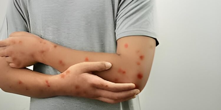 Se confirma caso de Mpox; el estado es la segunda entidad con más contagios