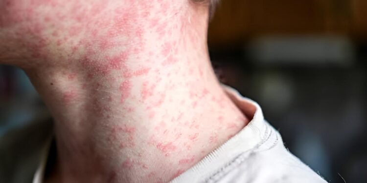 Sarampión repunta en Yucatán y activan llamado urgente a vacunarse